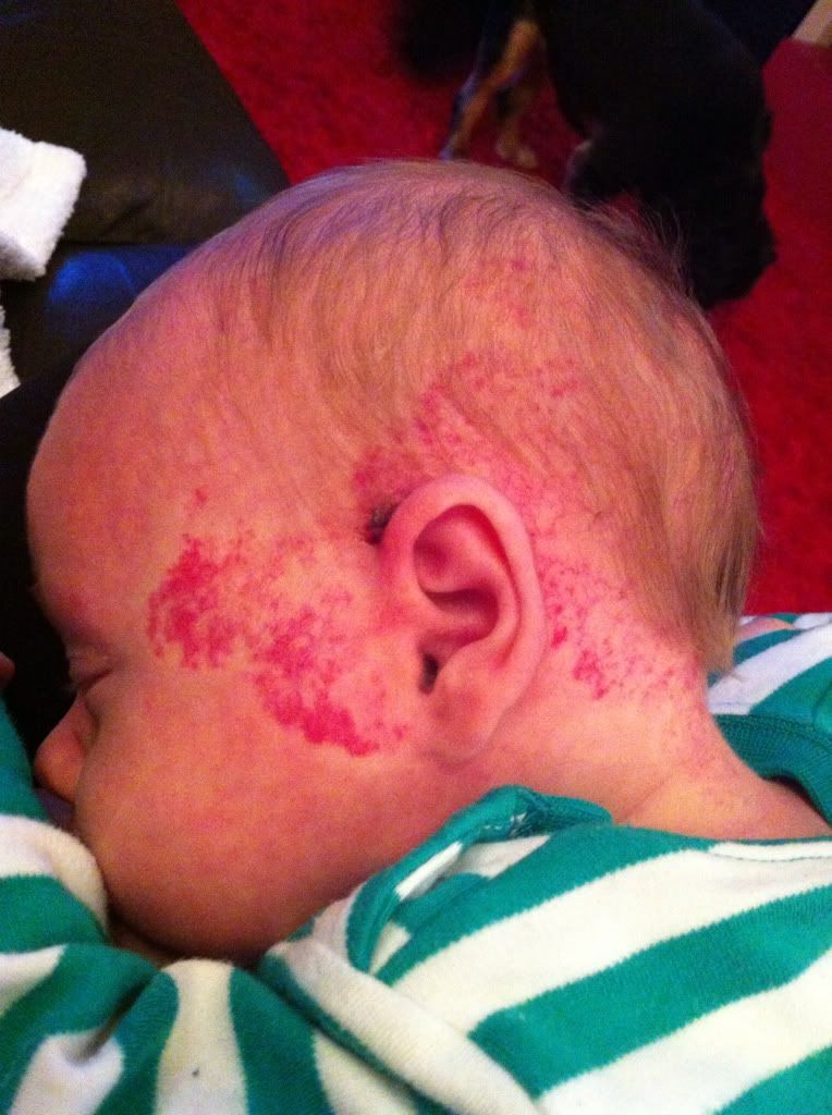 Birthmark - UPDATE 2! Further Down P1 - Birthmarks/Hemangiomas - BabyCentre