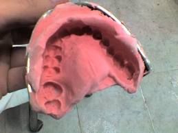 protesis dental casera protesis dental casera