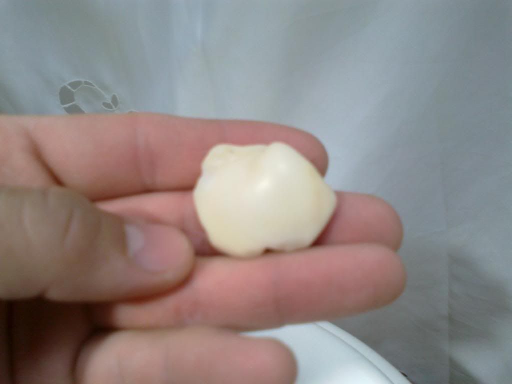 protesis dental casera (para 1 incisivo central) protesis dental casera (para 1 incisivo central)