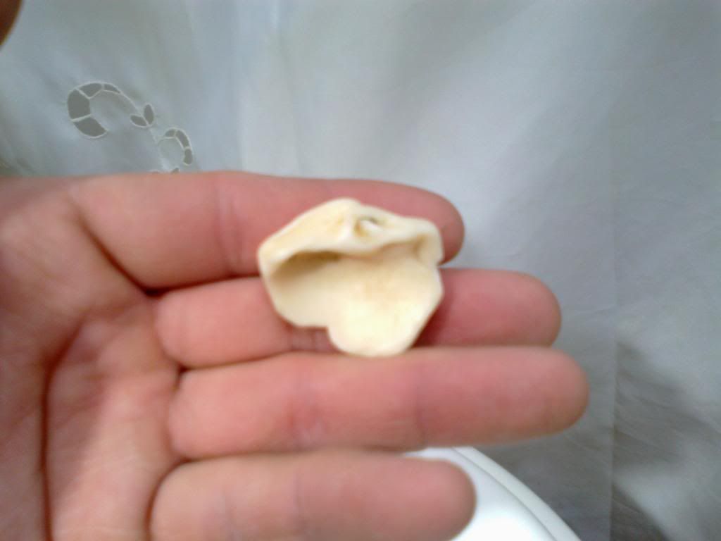 protesis dental casera protesis dental casera