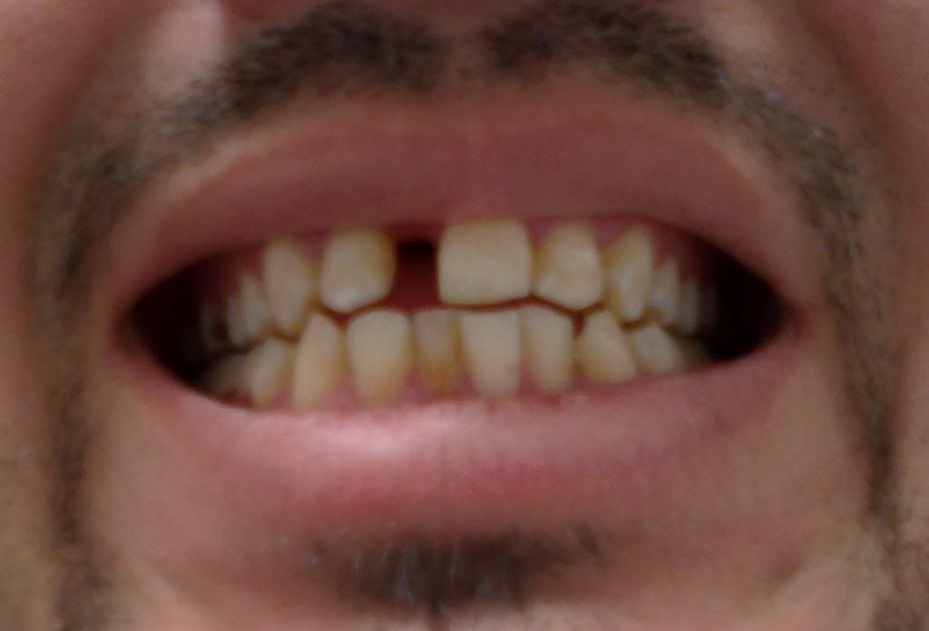 protesis dental casera (para 1 incisivo central) protesis dental casera (para 1 incisivo central)